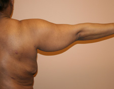 fat hanging from the upper arms